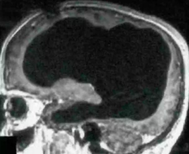 Чоловік випадково виявив, що живе з половиною мозку – фото