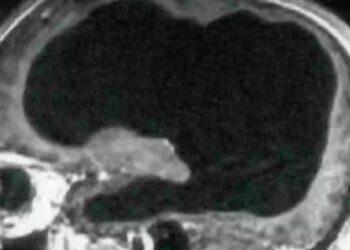 Чоловік випадково виявив, що живе з половиною мозку – фото