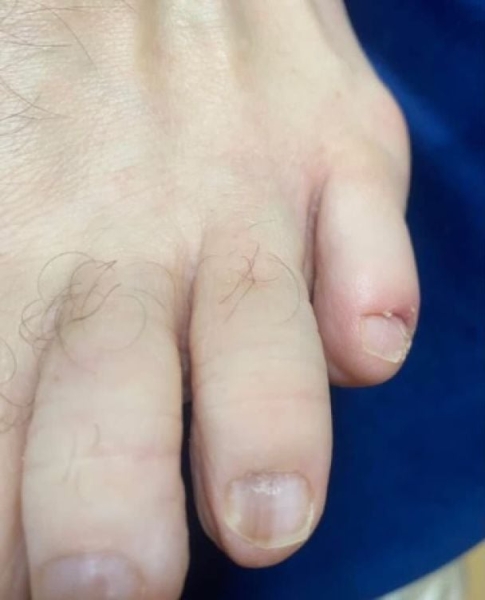 Дружина виявила на нігті чоловіка ранню ознаку раку, яку не помітили лікарі – фото