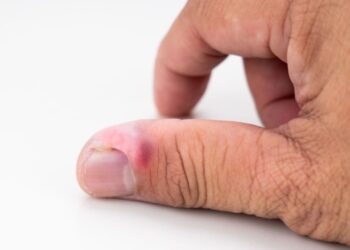 Гнійник біля нігтя: як лікувати та уникнути ускладнень