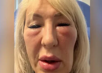 “Я заплатила псевдолікарю тисячі доларів за філери для обличчя – і тепер виглядаю як гаргулья”