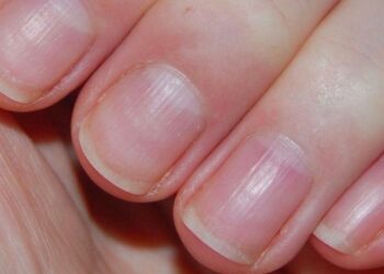Нігті стали ребристими: чому так сталося та що робити в такому випадку