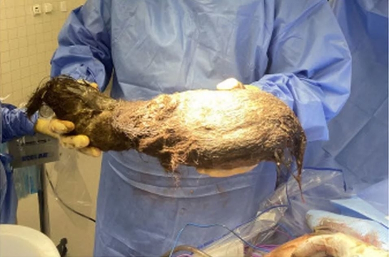 Зі шлунка 15-річної дівчинки видалили 2,4 кг волосся – фото