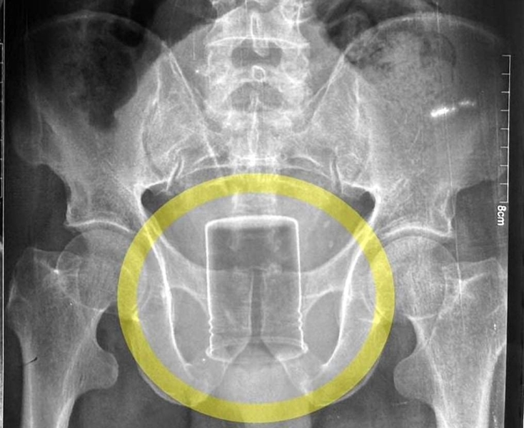 Фермер шість тижнів ходив із банкою з хімікатом у сідницях: чим це закінчилося (фото)