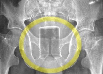 Фермер шість тижнів ходив із банкою з хімікатом у сідницях: чим це закінчилося (фото)