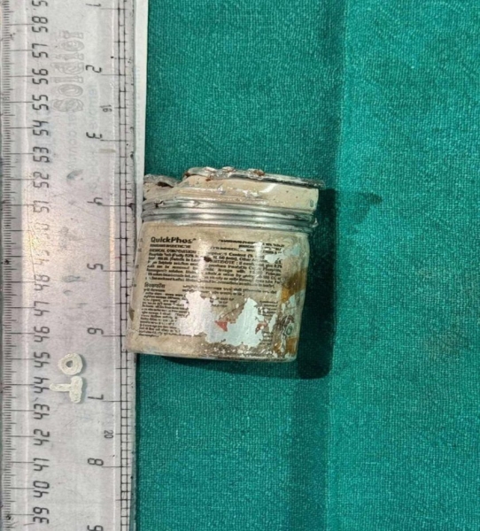 Фермер шість тижнів ходив із банкою з хімікатом у сідницях: чим це закінчилося (фото)