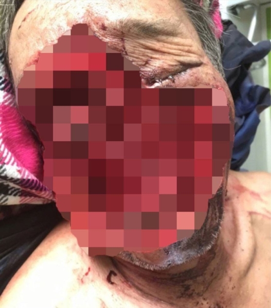 Хірурги врятували чоловіка, якому ведмідь роздер обличчя: який він зараз має вигляд (фото)