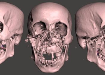 Хірурги врятували чоловіка, якому ведмідь роздер обличчя: який він зараз має вигляд (фото)