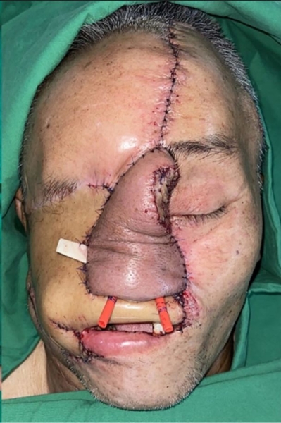 Хірурги врятували чоловіка, якому ведмідь роздер обличчя: який він зараз має вигляд (фото)