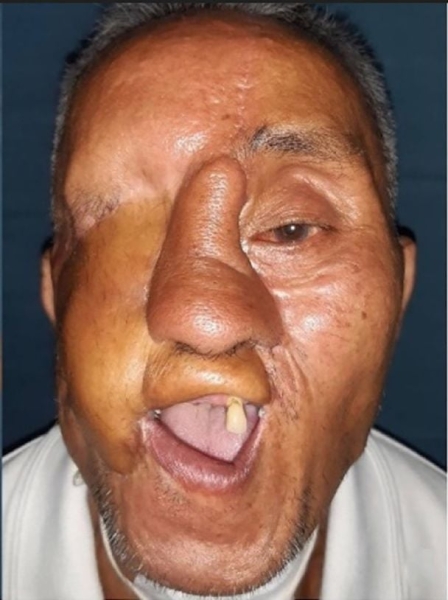 Хірурги врятували чоловіка, якому ведмідь роздер обличчя: який він зараз має вигляд (фото)