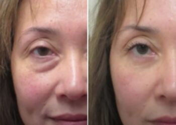 Всього одна аптечна мазь прибере набряки та мішки під очима не гірше косметолога