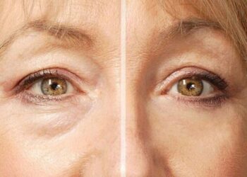 Ці 3 аптечні засоби усунуть мішки під очима та підтягніть шкіру не гірше дорогих кремів