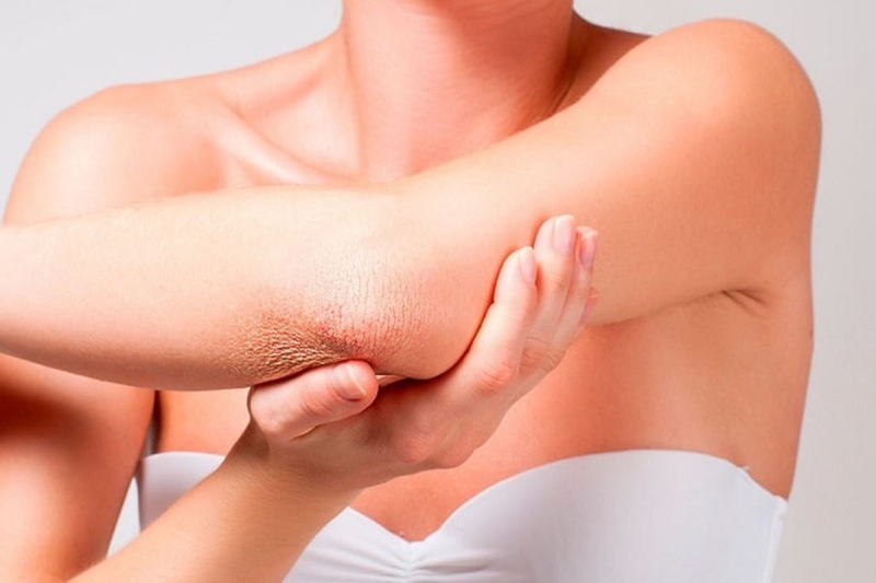 Суха шкіра на ліктях — чому і як це виправити