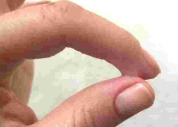 Вас більше не буде мучити це питання: як швидко видалити суперклей зі шкіри