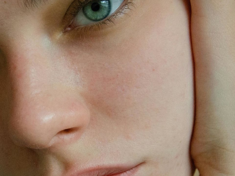 Приховані винуватці акне: як ваш шампунь та засоби для волосся можуть спричинити прищі